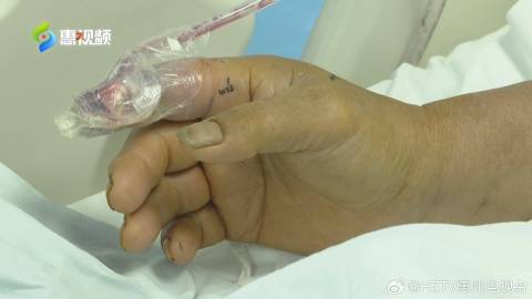 男子徒手抓蛇被咬,生死边缘的4次抢救 男子徒手抓蛇被咬,生死边缘的4次抢救